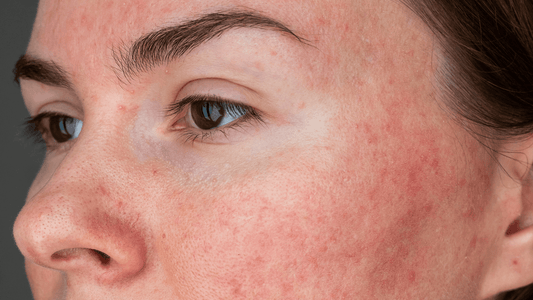 Kolostrum-Hydrofluid und Rosacea