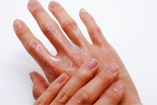 Trockene Hände im Winter